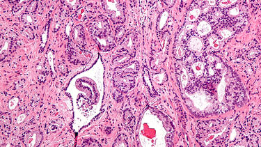 A micrograph showing prostatic acinar adenocarcinoma, the most common form of prostate cancer. Photo: Nephron/Wikimedia.