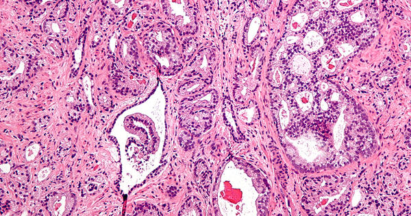 A Decision Analysis Approach Points to Better Diagnosis of Prostate ...