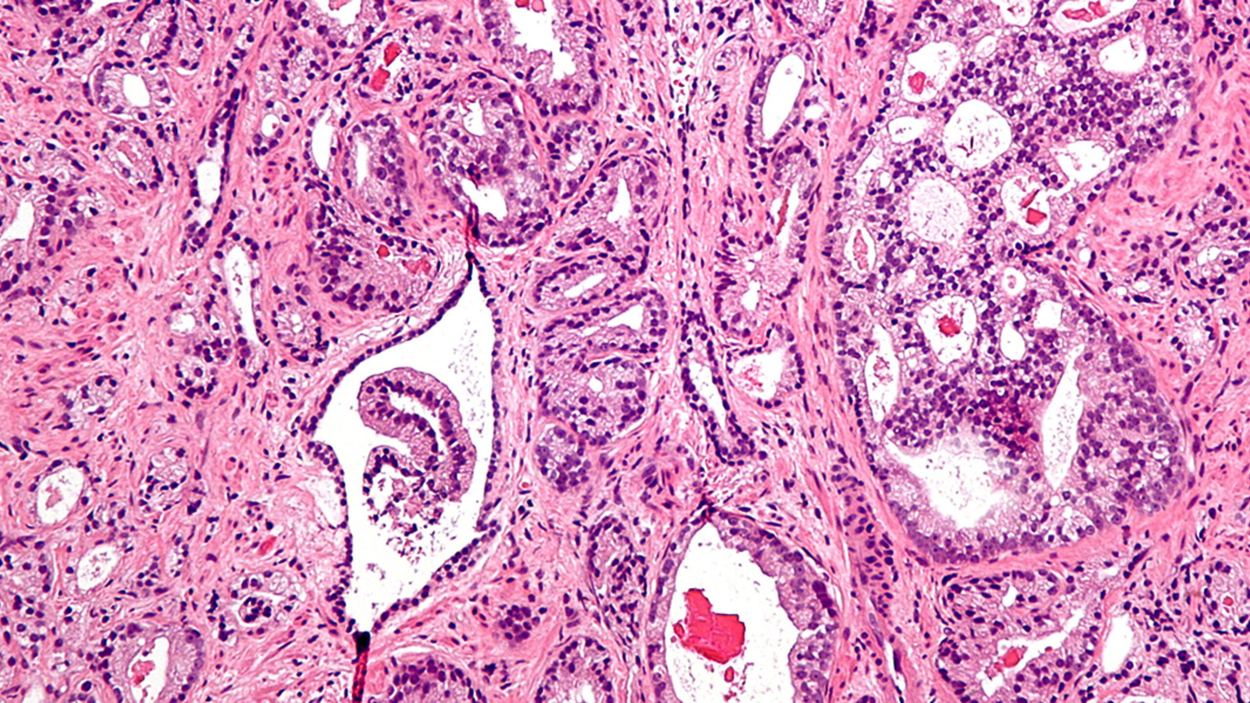 A micrograph showing prostatic acinar adenocarcinoma, the most common form of prostate cancer. Photo: Nephron/Wikimedia.